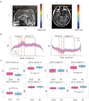 Abnormal focal segments in left uncinate fasciculus in adults with obsessive–compulsive disorder